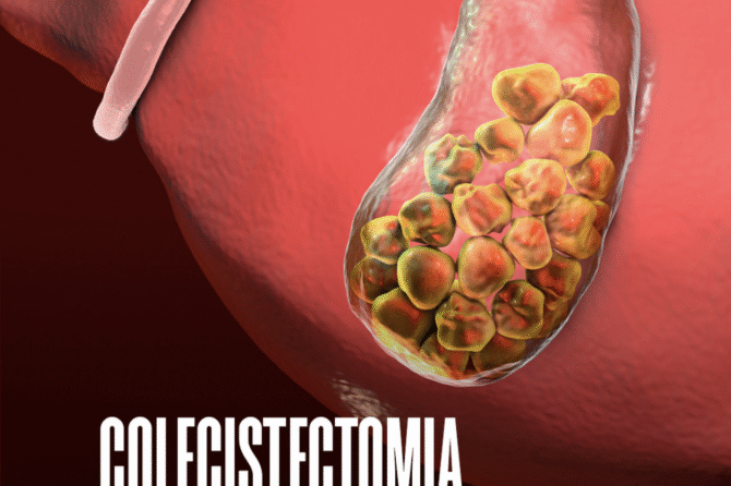 COLECISTECTOMIA: A cirurgia da retirada de vesícula biliar