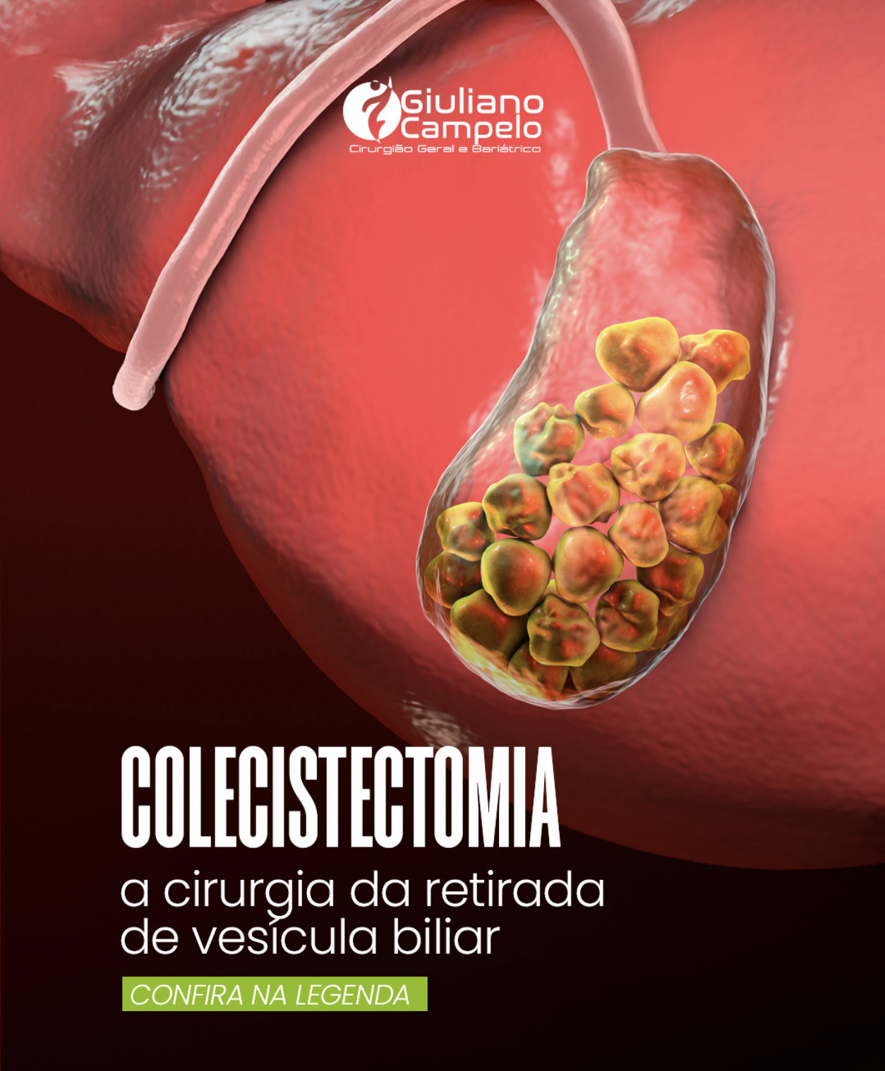 COLECISTECTOMIA: A cirurgia da retirada de vesícula biliar