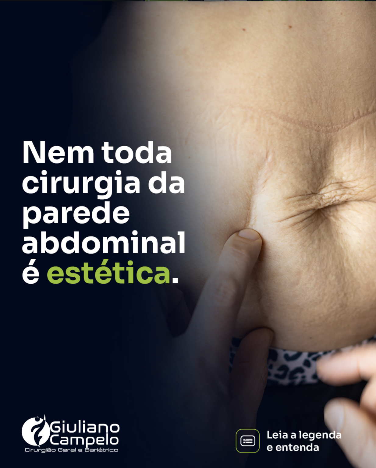 Nem toda cirurgia da parede abdominal é estética